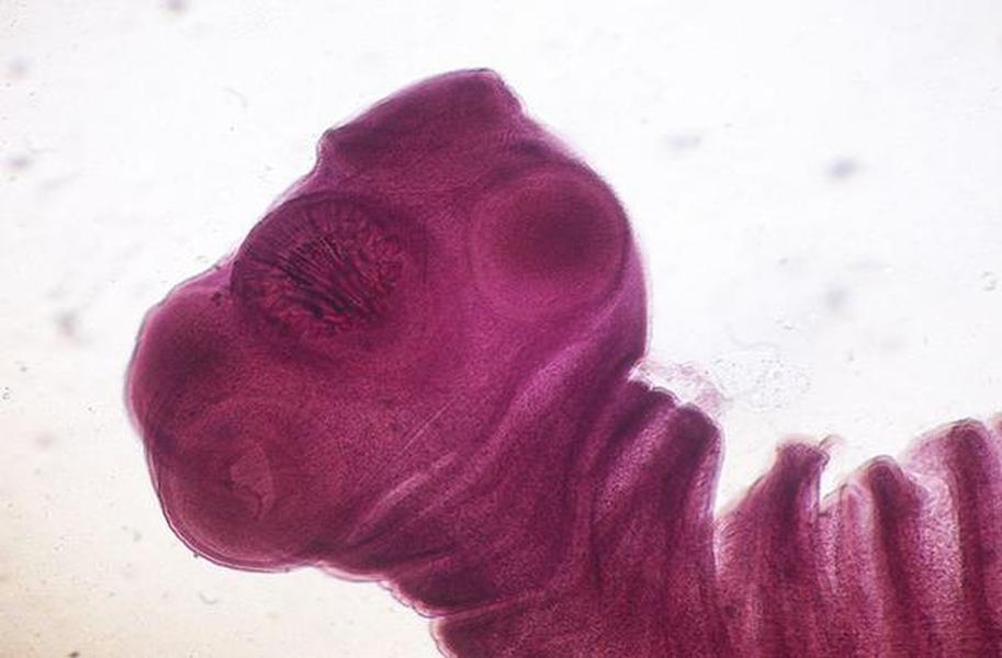 Here&#039;s how a worm survived burrowed in a man&#039;s head for 4 years