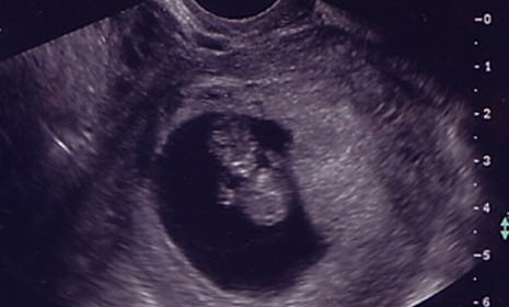 An ultrasound image of a fetus just over nine weeks. 