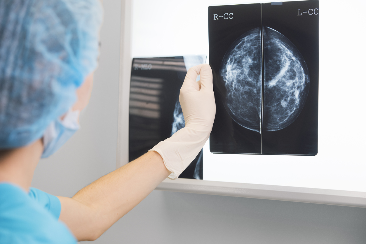 Mammogram x-ray.