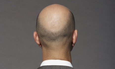 Forget spray-on hair, or those unsightly plugs, scientists believe human stem cells are the final answer to baldness.