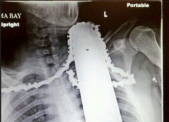Man &#039;lucky&#039; to survive a chainsaw slicing through his neck and shoulder