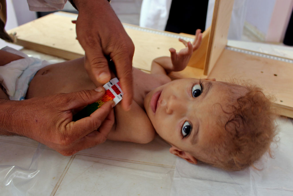 A Yemeni child suffering from severe malnutrition is measured at a treatment centre in a hospital in Yemen&#039;s northwestern Hajjah province, on November 7, 2018. 