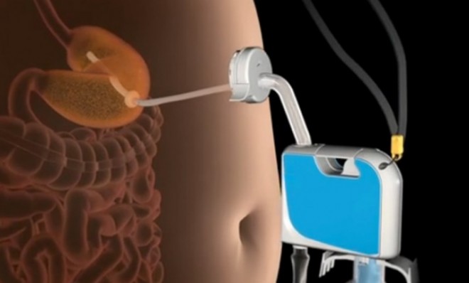 The AspireAssist empties 30 percent of the contents of a person&#039;s stomach into the toilet.