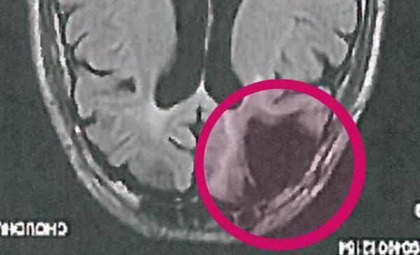 Cecil Clayton&#039;s brain scan.