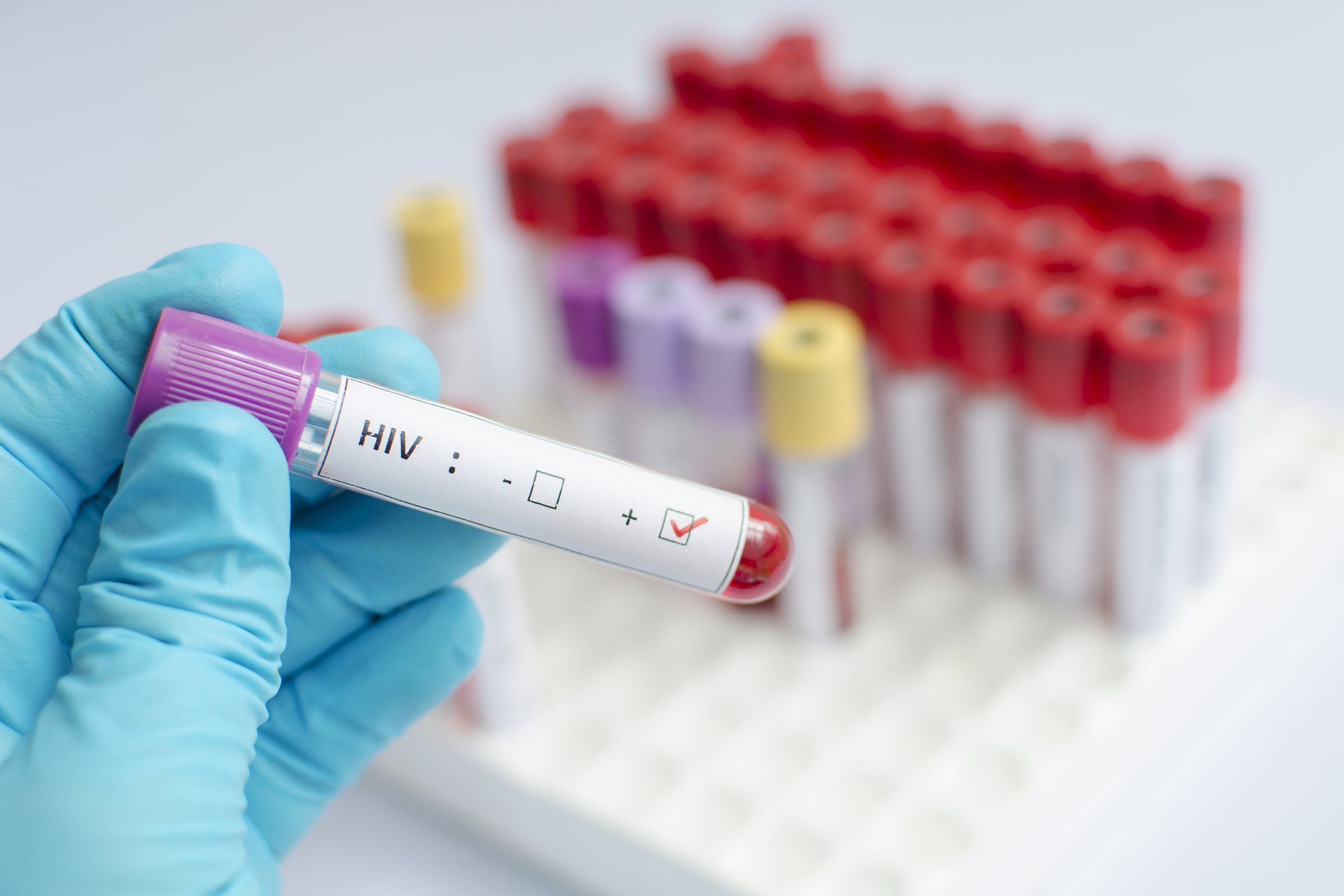 HIV blood sample.