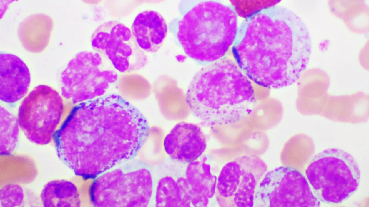 Chronic myeloid leukemia cells.